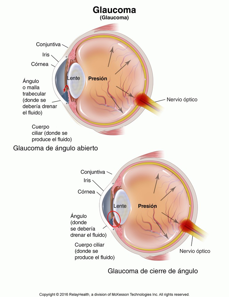 Glaucoma: Illustration
