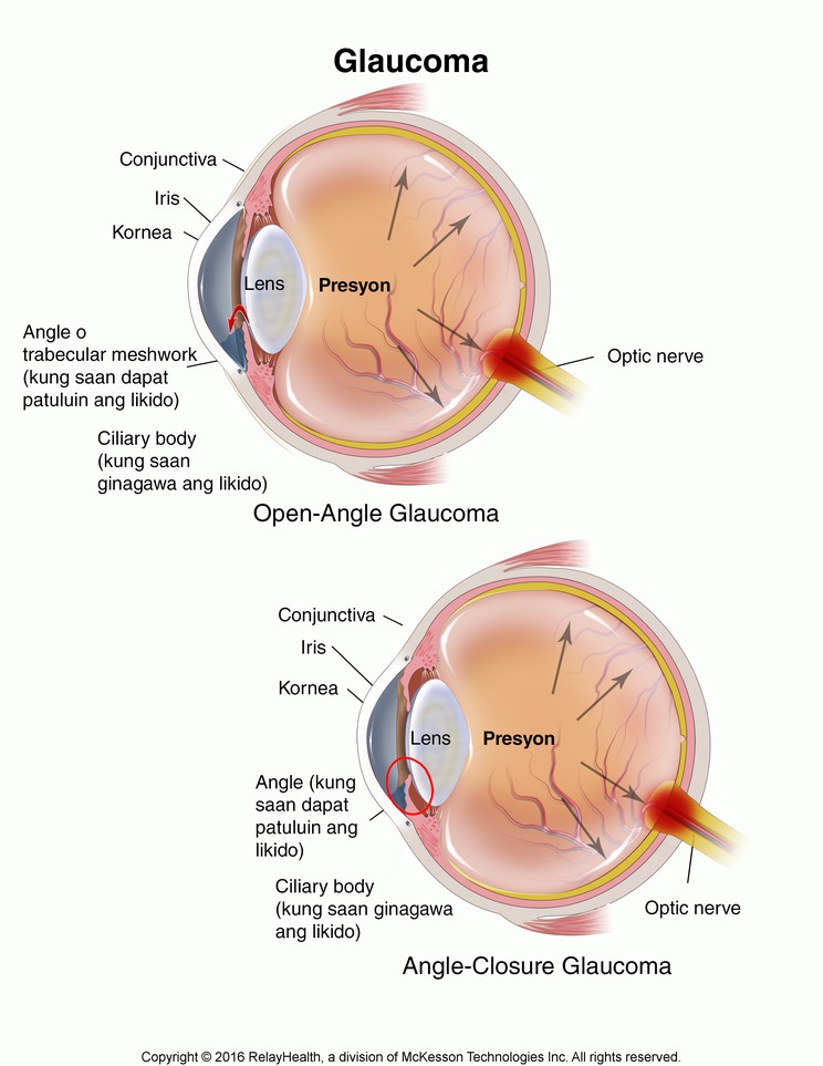 Glaucoma: Illustration