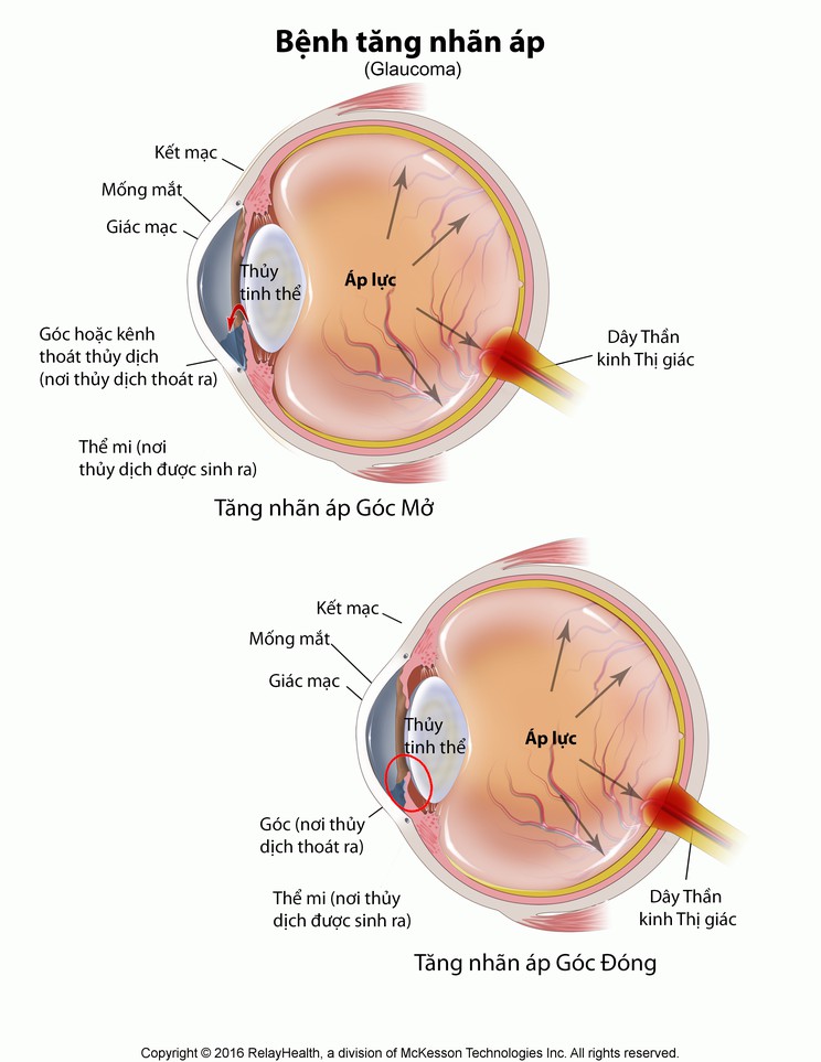 Glaucoma: Illustration