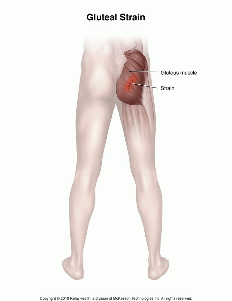 Gluteal Strain: Illustration