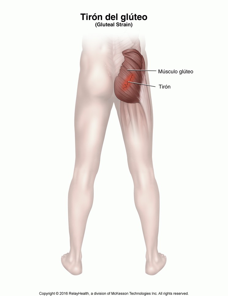 Gluteal Strain: Illustration