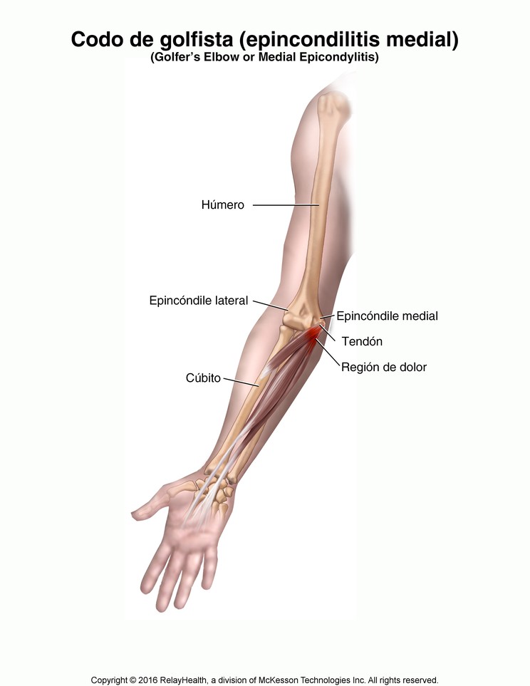 Golfer's Elbow (Medial Epicondylitis): Illustration