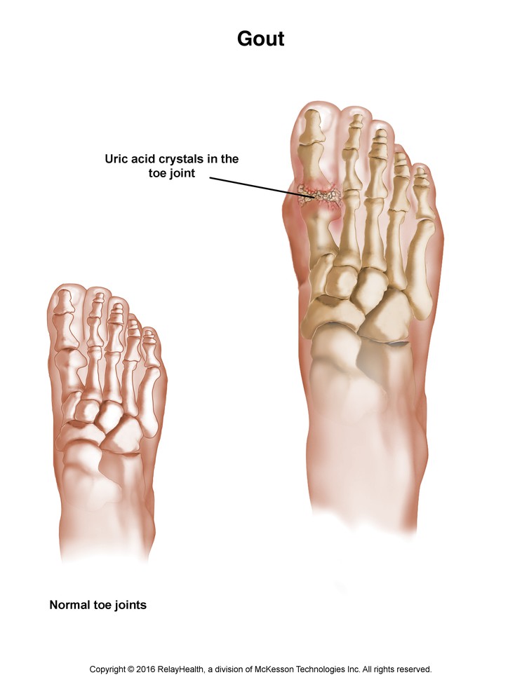 Gout: Illustration