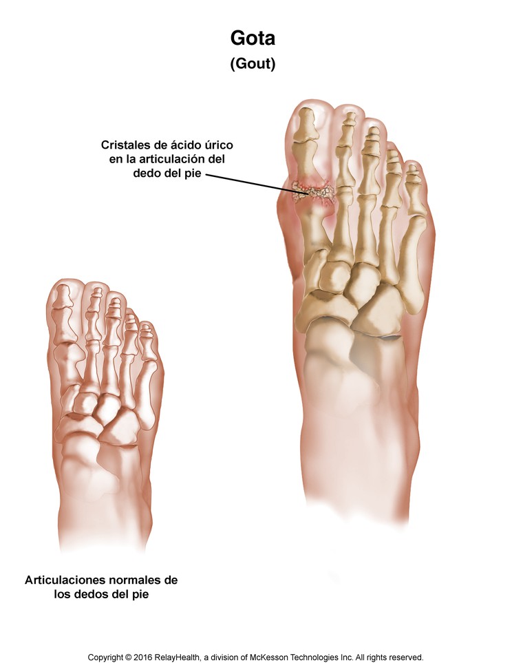 Gout: Illustration