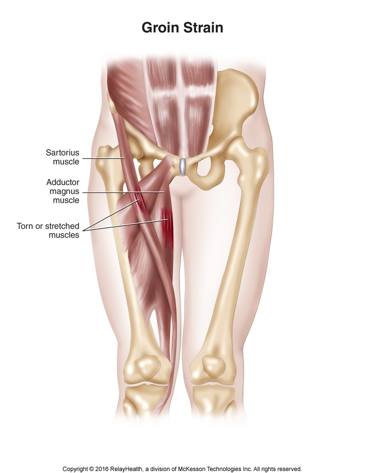 Groin Strain: Illustration
