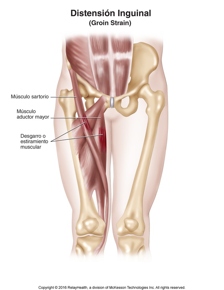 Groin Strain: Illustration