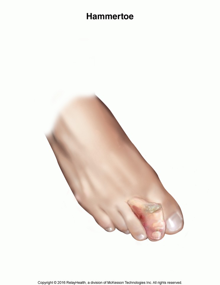 Hammertoe: Illustration