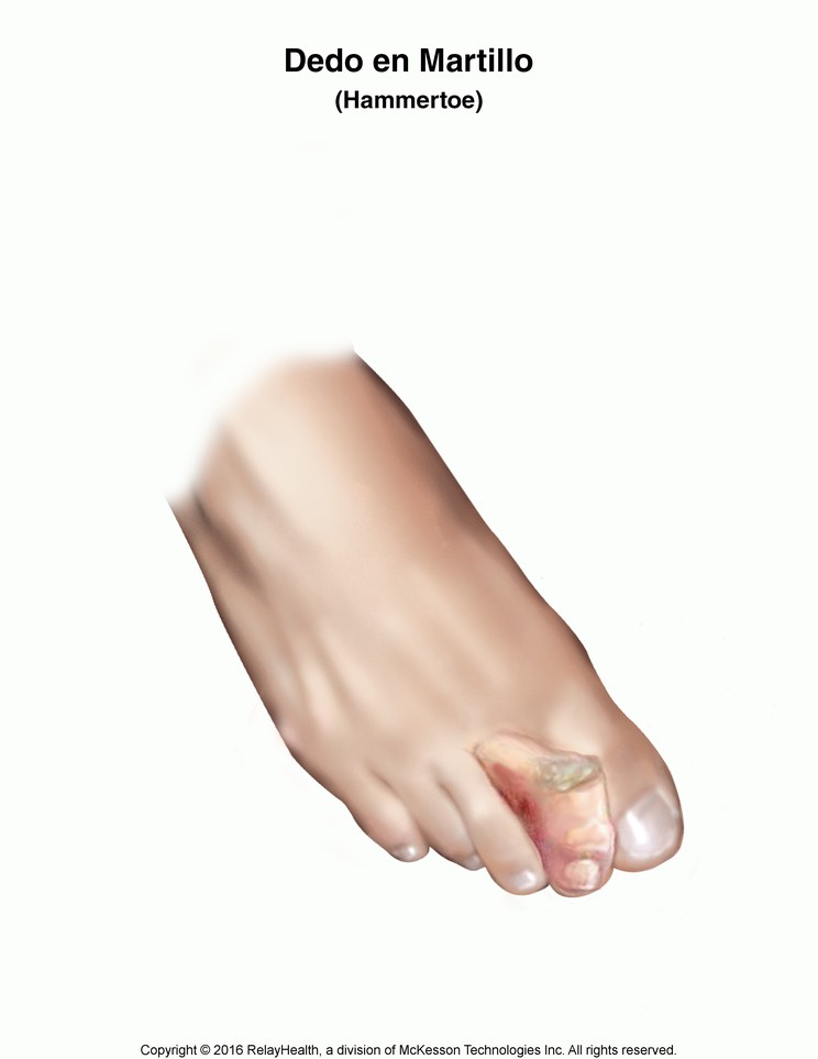 Hammertoe: Illustration