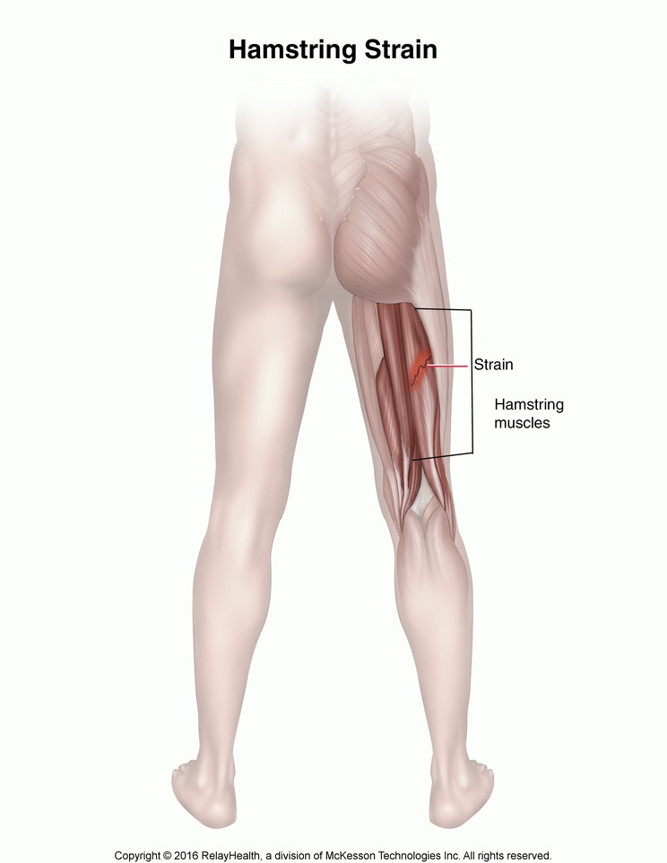 Hamstring Strain: Illustration