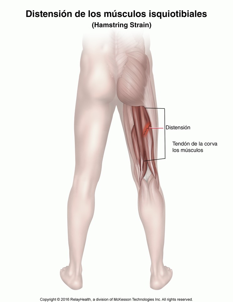 Hamstring Strain: Illustration