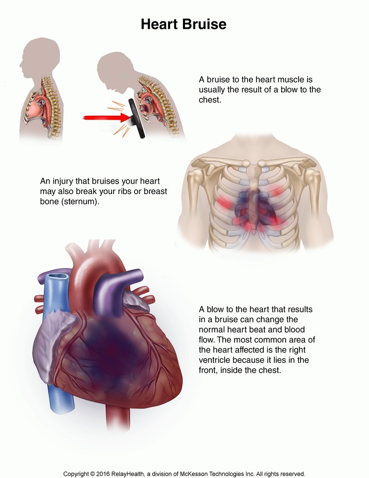 Heart Bruise: Illustration