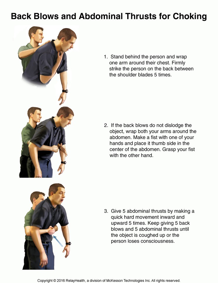 Back Blows and Abdominal Thrusts for Choking: Illustration