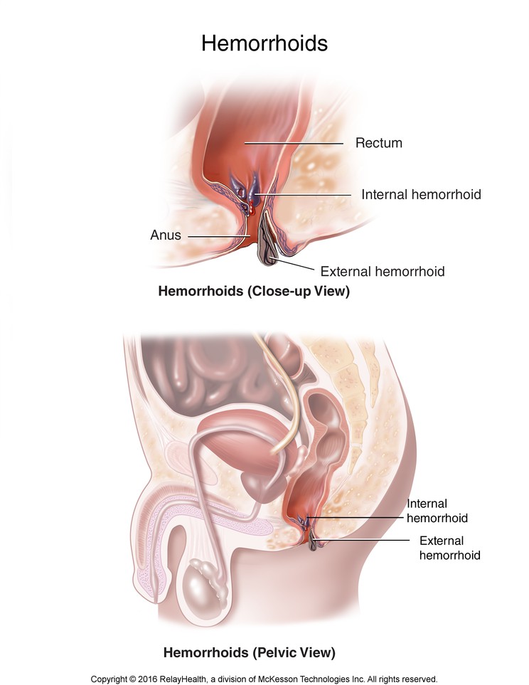 Hemorrhoids: Illustration