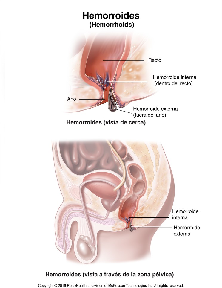 Hemorrhoids: Illustration