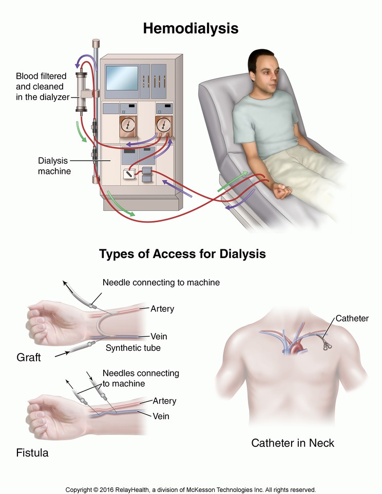 Hemodialysis: Illustration