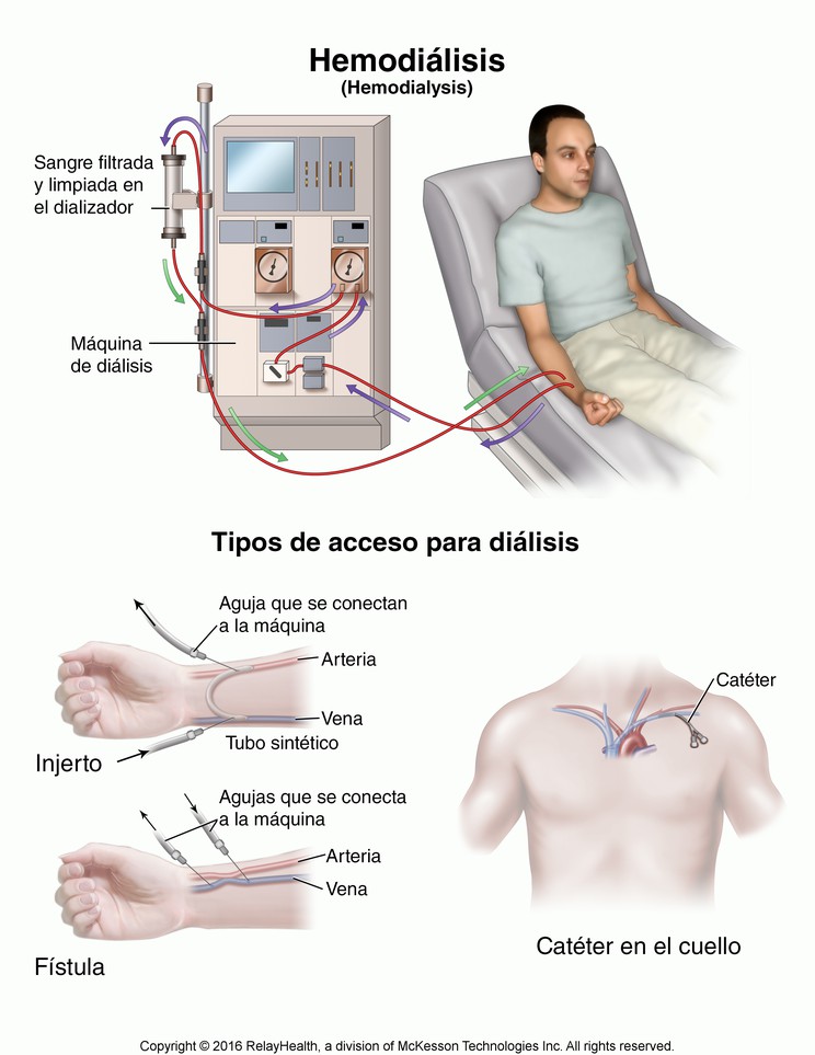 Kidney Dialysis: Hemodialysis Illustration
