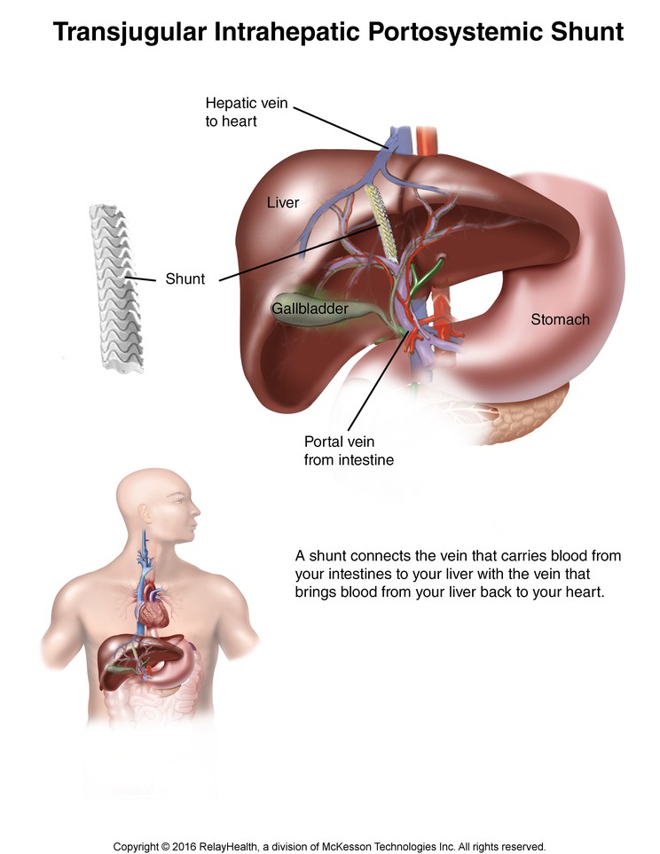 Transjugular Intrahepatic Portosystemic Shunt: Illustration