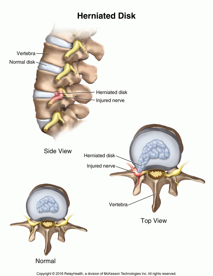 Herniated Disk: Illustration