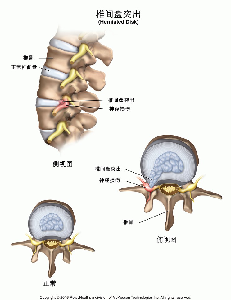 Herniated Disk: Illustration