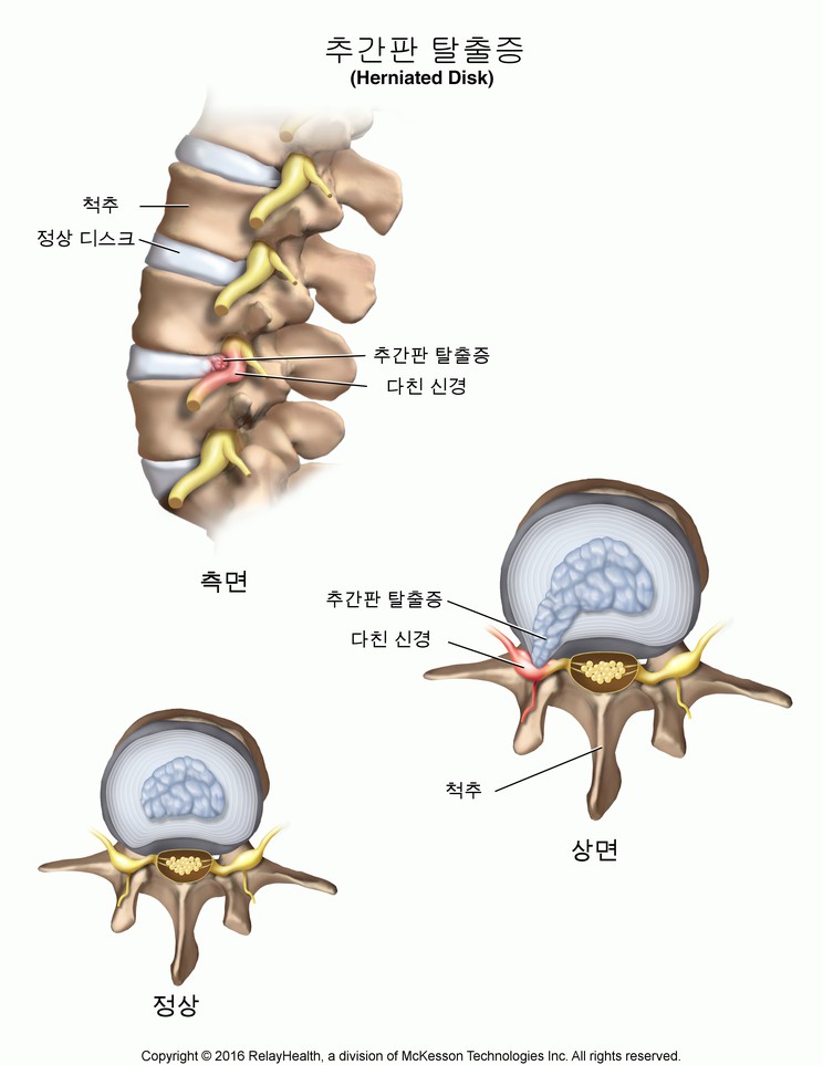 Herniated Disk: Illustration