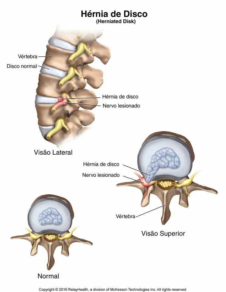 Herniated Disk: Illustration