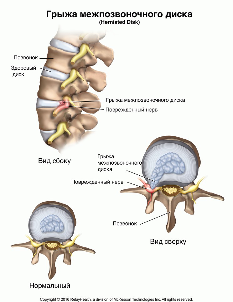 Herniated Disk: Illustration