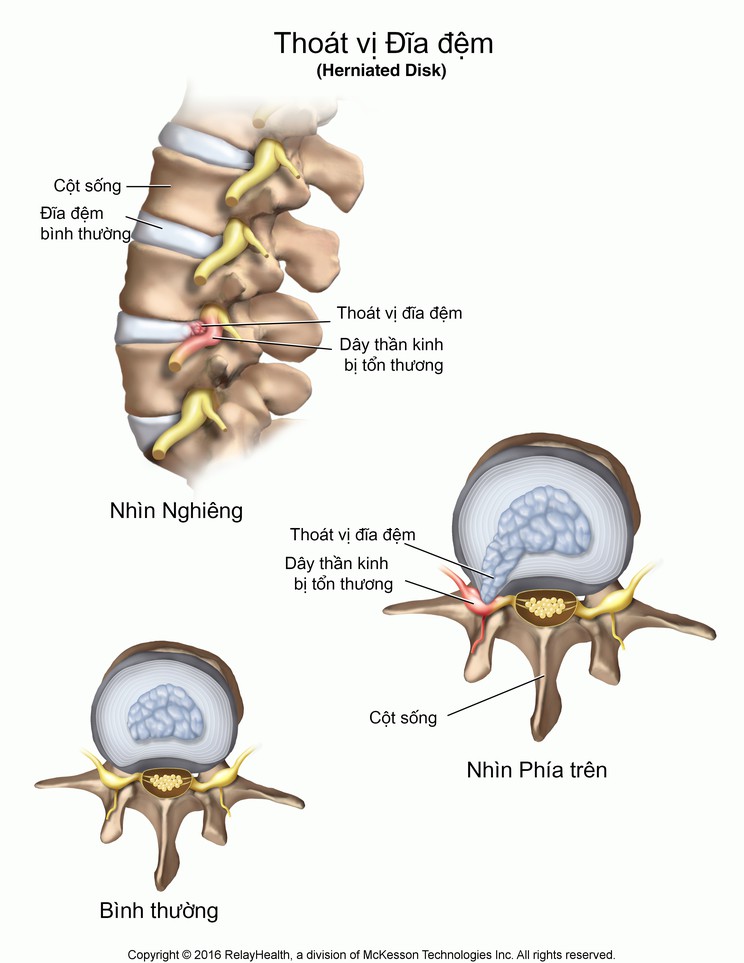 Herniated Disk: Illustration