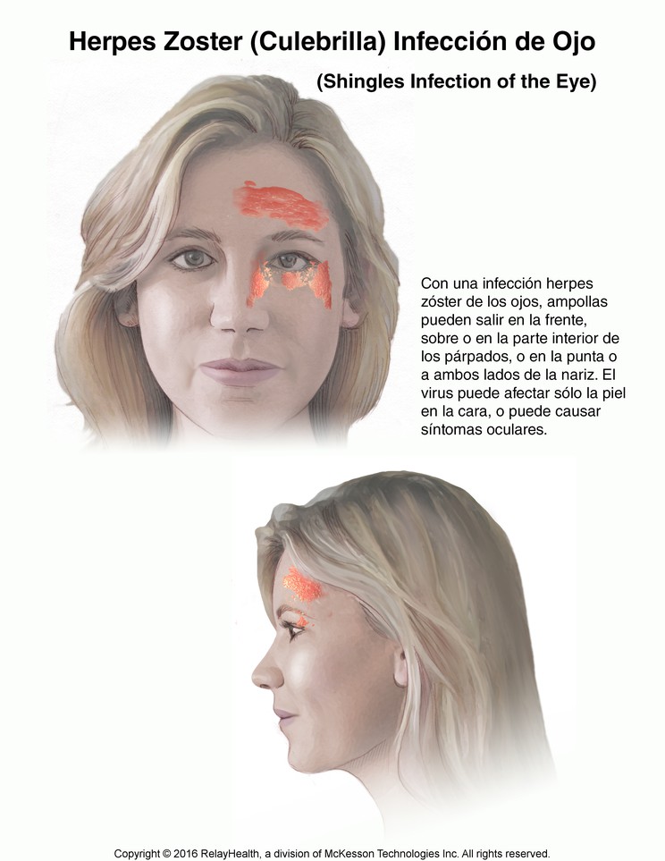 Herpes Zoster (Shingles) Eye Infection: Illustration