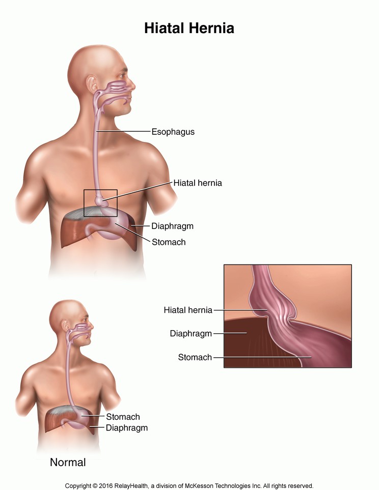 Hiatal Hernia: Illustration