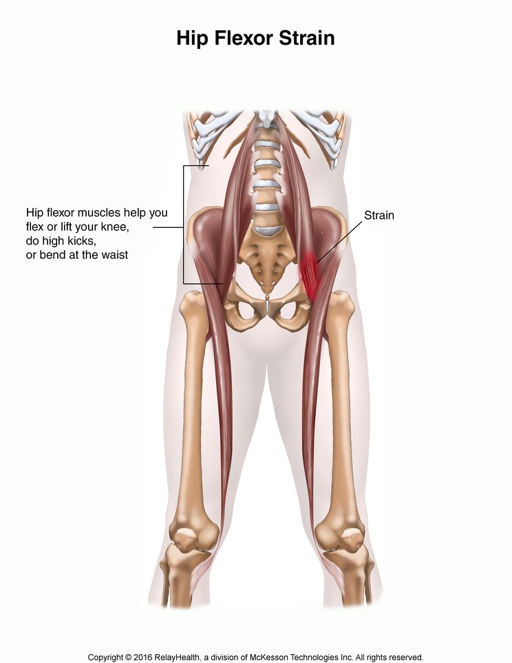Hip Flexor Strain: Illustration