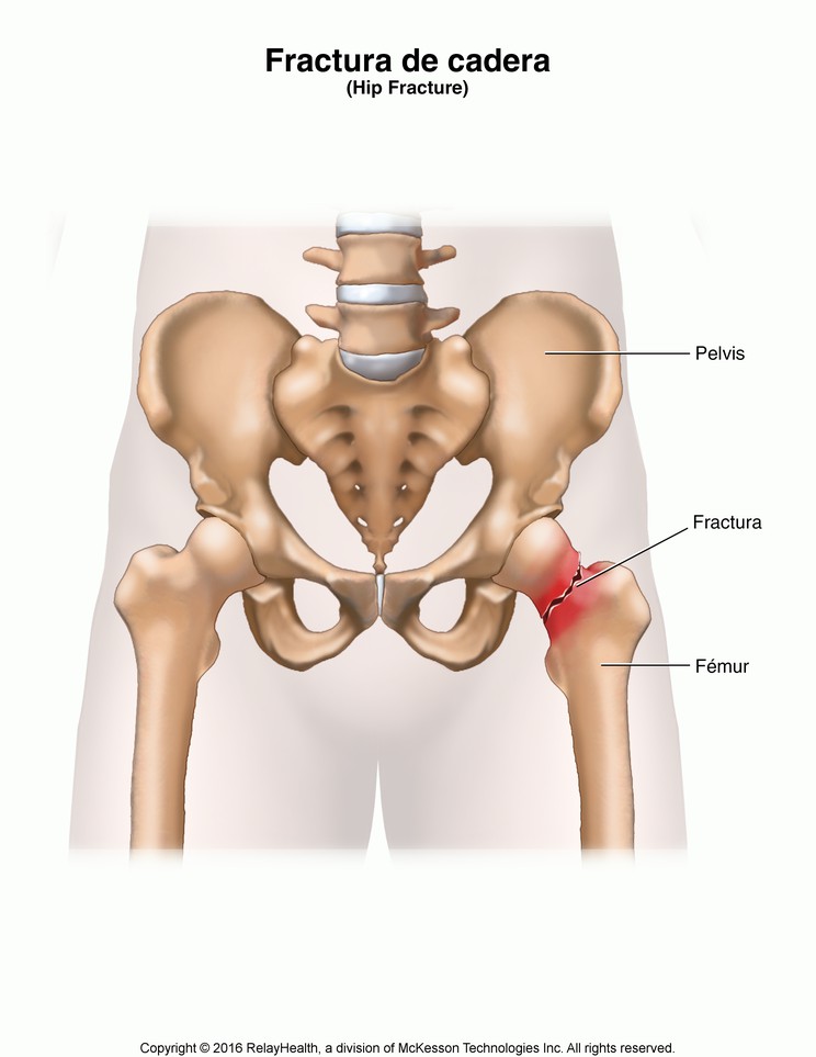 Hip Fracture: Illustration
