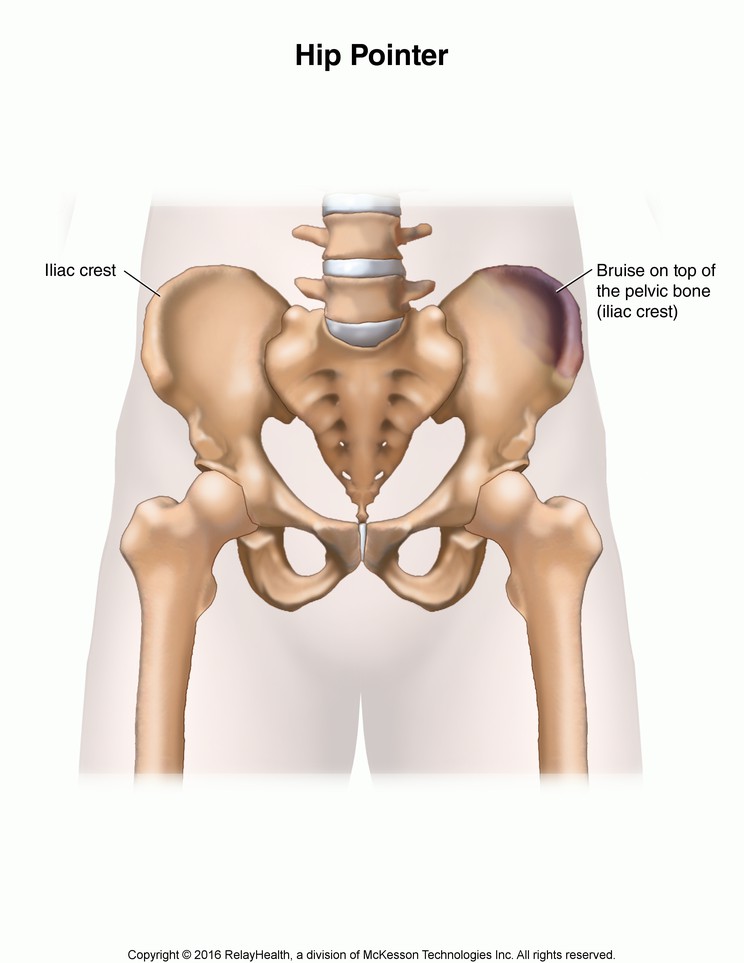 Hip Pointer: Illustration