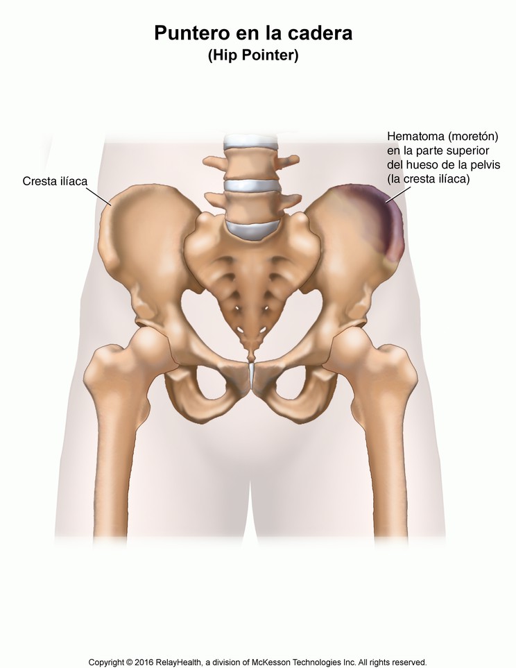 Hip Pointer: Illustration