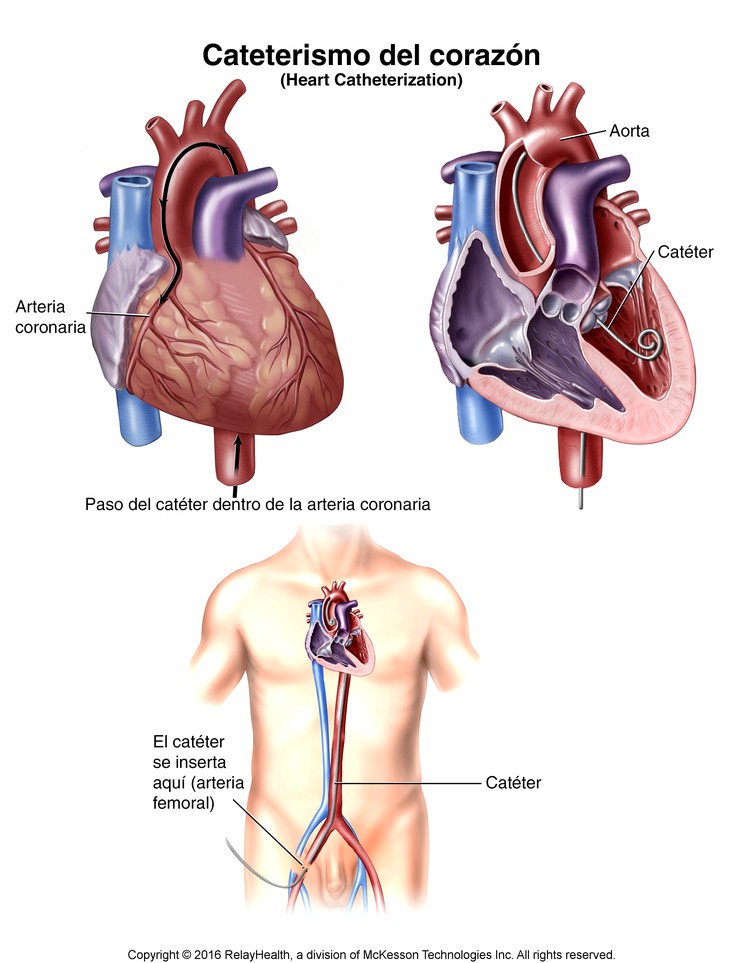 Heart Catheterization: Illustration