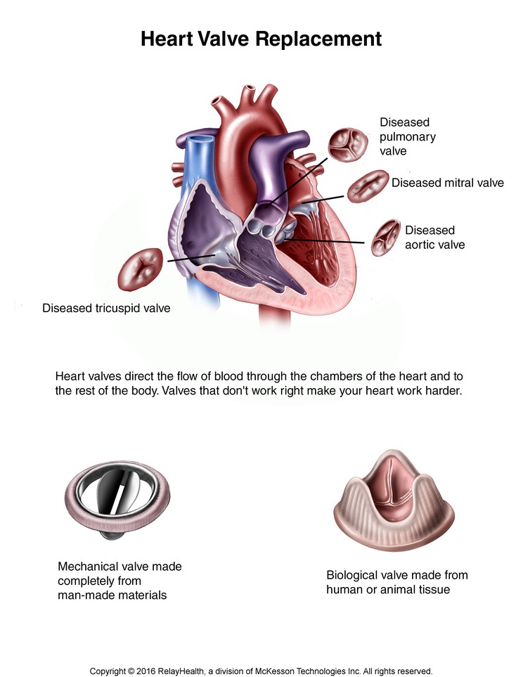 Heart Valve Replacement: Illustration