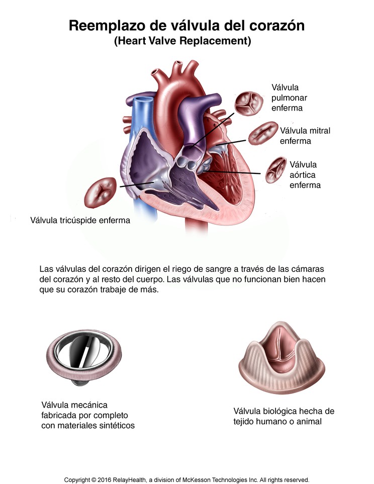 Heart Valve Replacement: Illustration