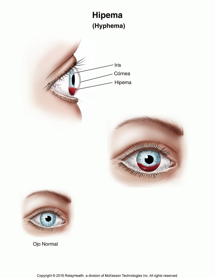 Hyphema: Illustration