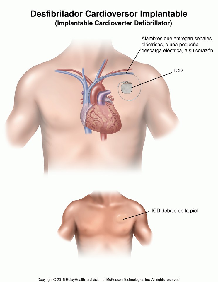 Implantable Cardioverter Defibrillator (ICD)