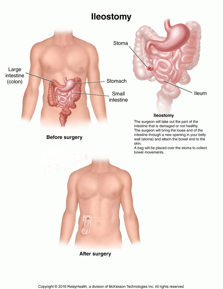 Ileostomy: Illustration