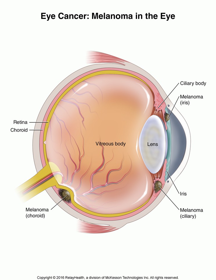 Eye Cancer: Melanoma in the Eye, Illustration