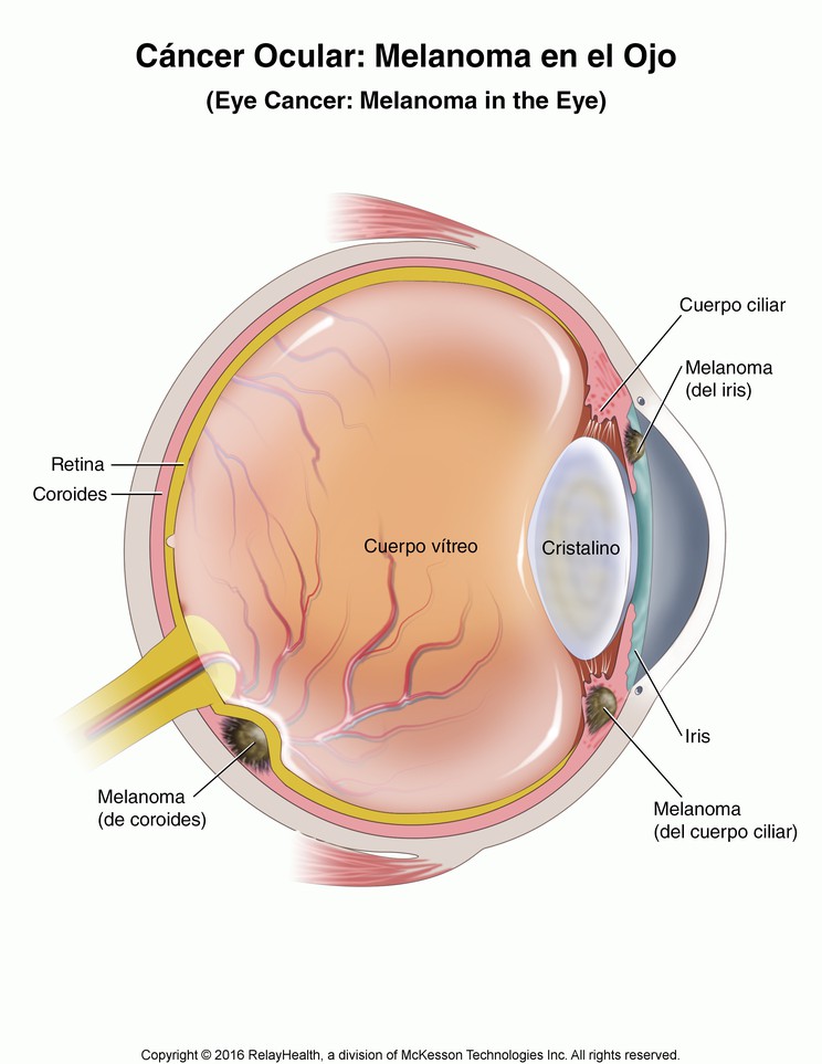 Eye Cancer: Melanoma in the Eye, Illustration