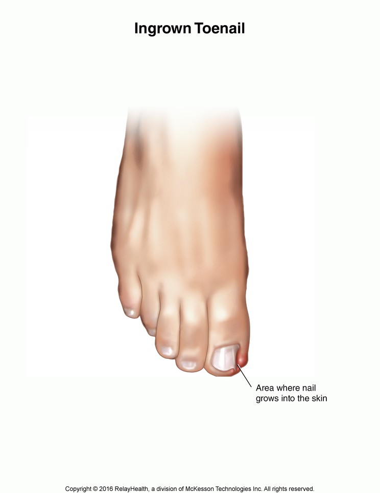 Ingrown Toenail: Illustration