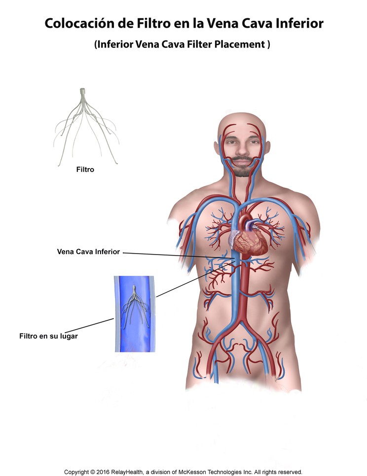 Inferior Vena Cava Filter Placement: Illustration