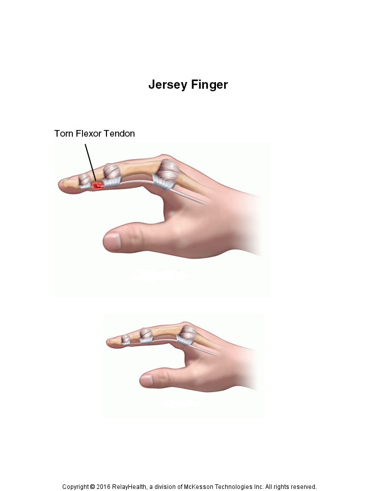 Jersey Finger: Illustration