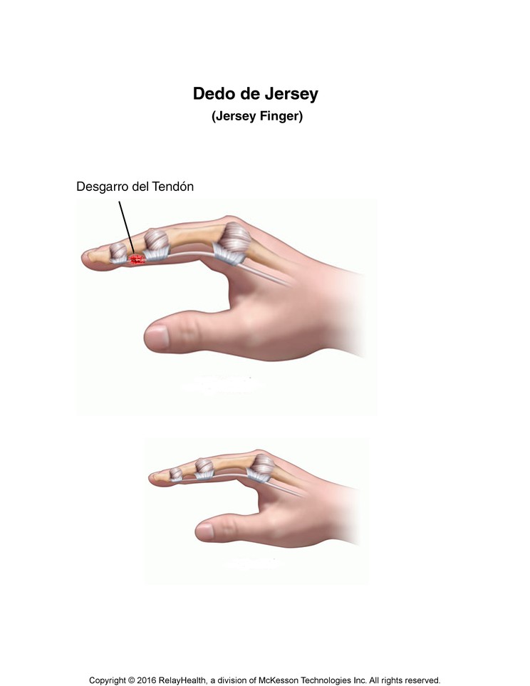 Jersey Finger: Illustration