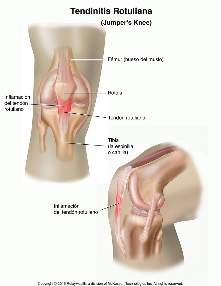 Jumper's Knee (Patellar Tendon Injury): Illustration