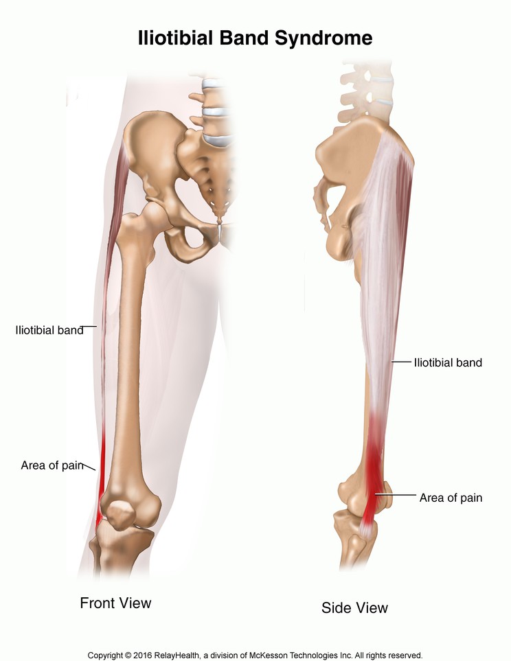 Iliotibial Band Syndrome: Illustration