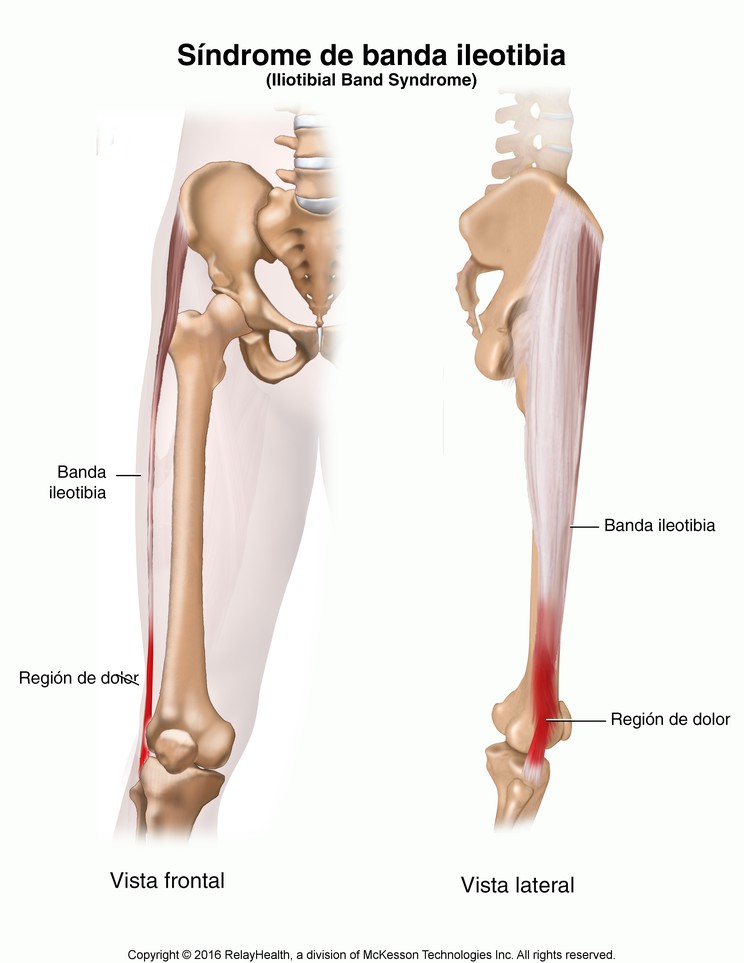 Iliotibial Band Syndrome: Illustration