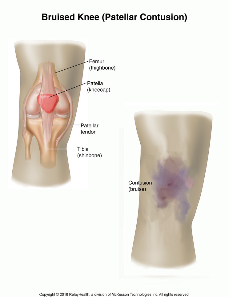 Bruised Knee (Patellar Contusion): Illustration