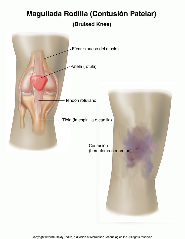 Bruised Knee (Patellar Contusion): Illustration